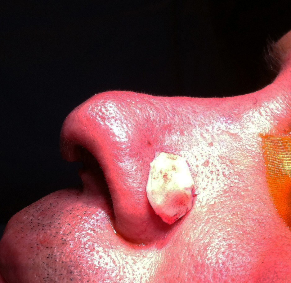 Alar Batten Graft position Dr Roth Rhinoplasty