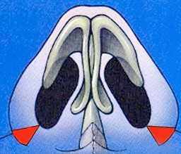 Alar base excision Dr Roth Rhinoplasty