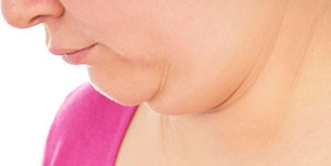 Dr Roth Neck Lift