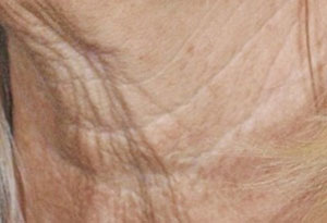 Dr Roth Neck Lift