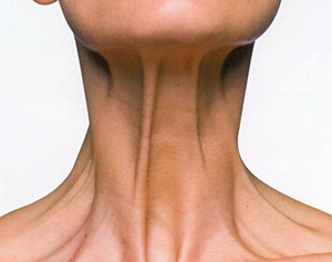 Dr Roth Neck Lift