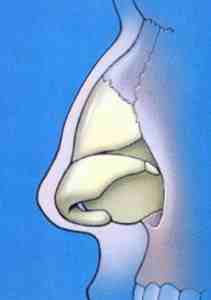 Dorsal Hump